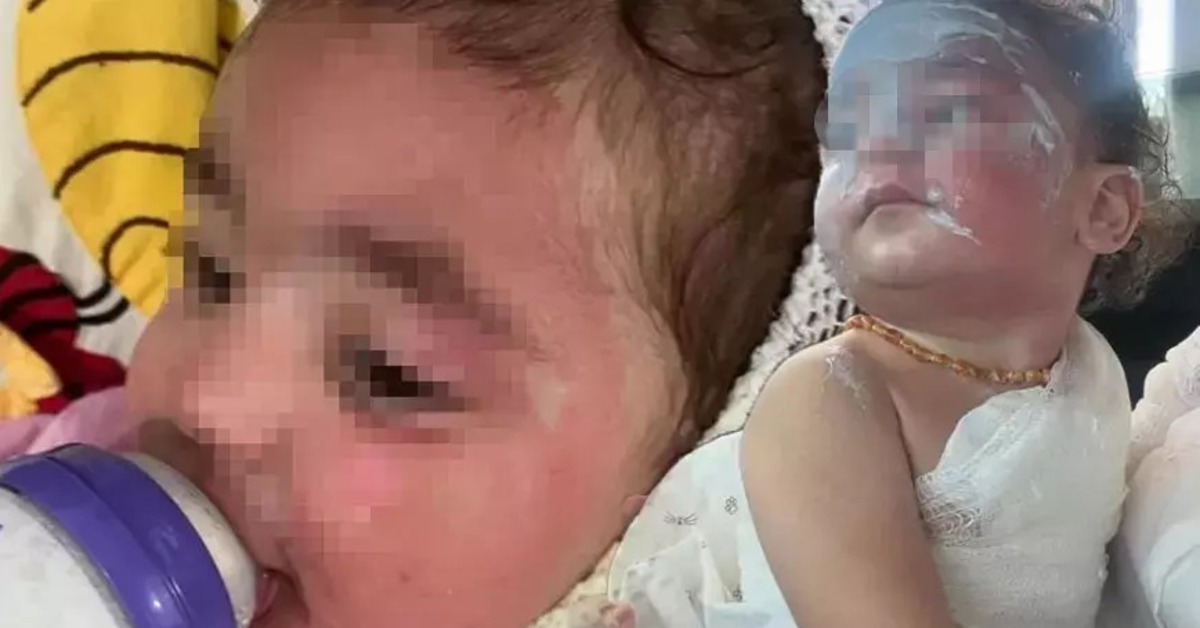 Kreşte çocuğun üzerine kahve döküldü