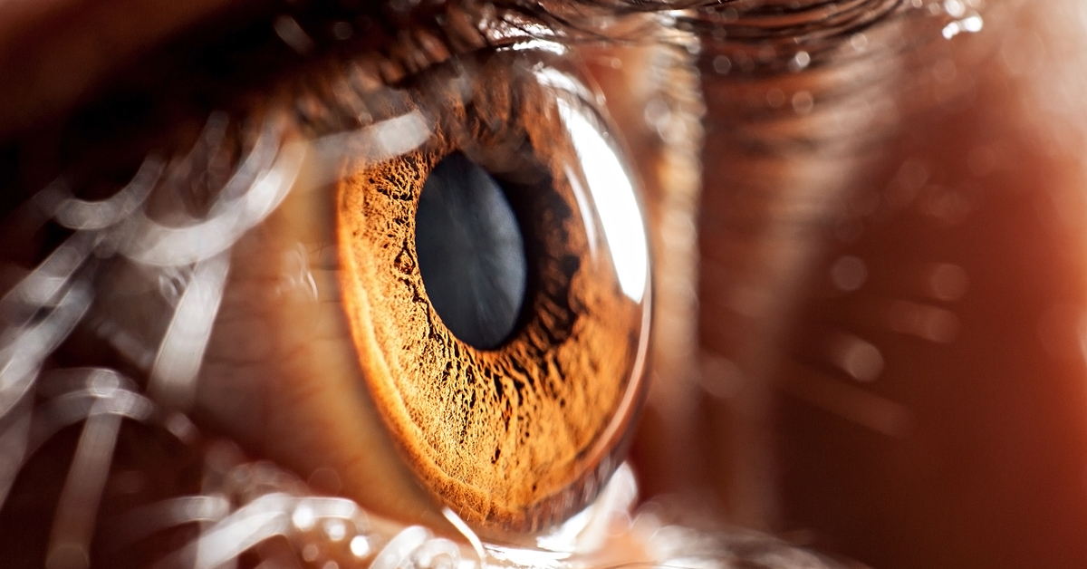 Keratokonus tedavi edilmezse 40’lı yaşlara kadar ilerleme gösteriyor